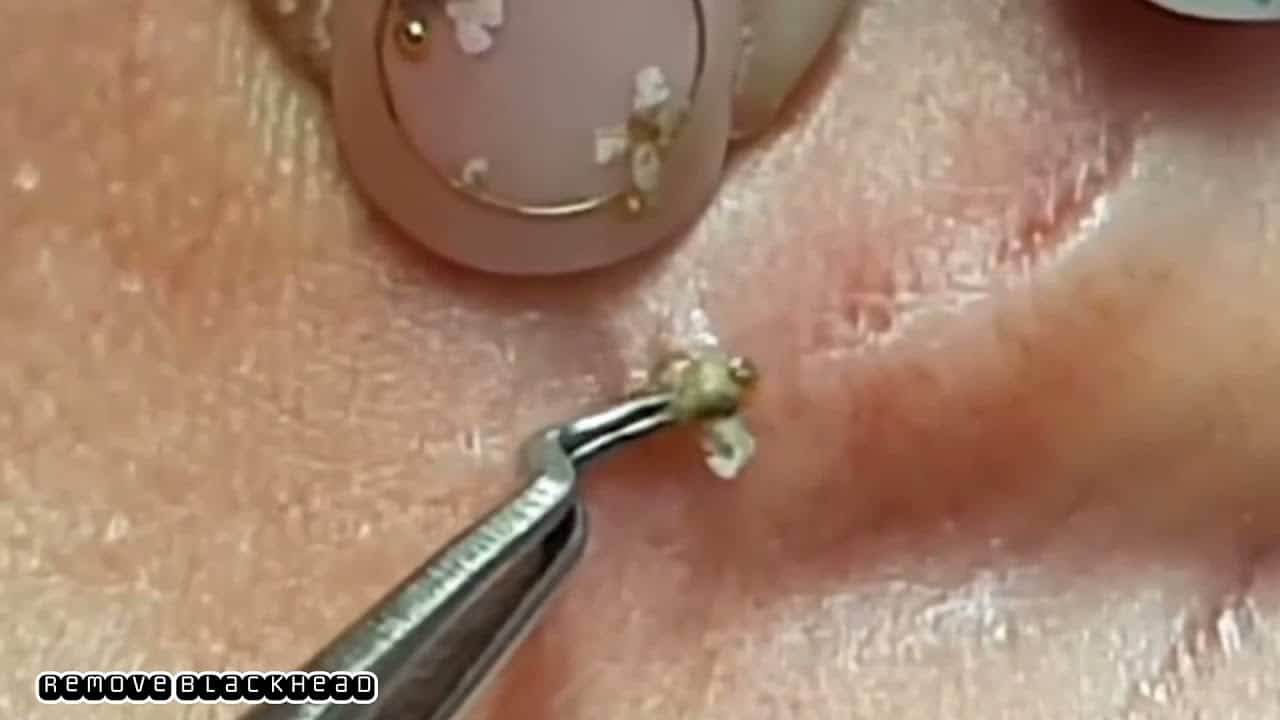 Blackheads on her Ear and nose Removal #remove #blackheads @Remove Blackhead