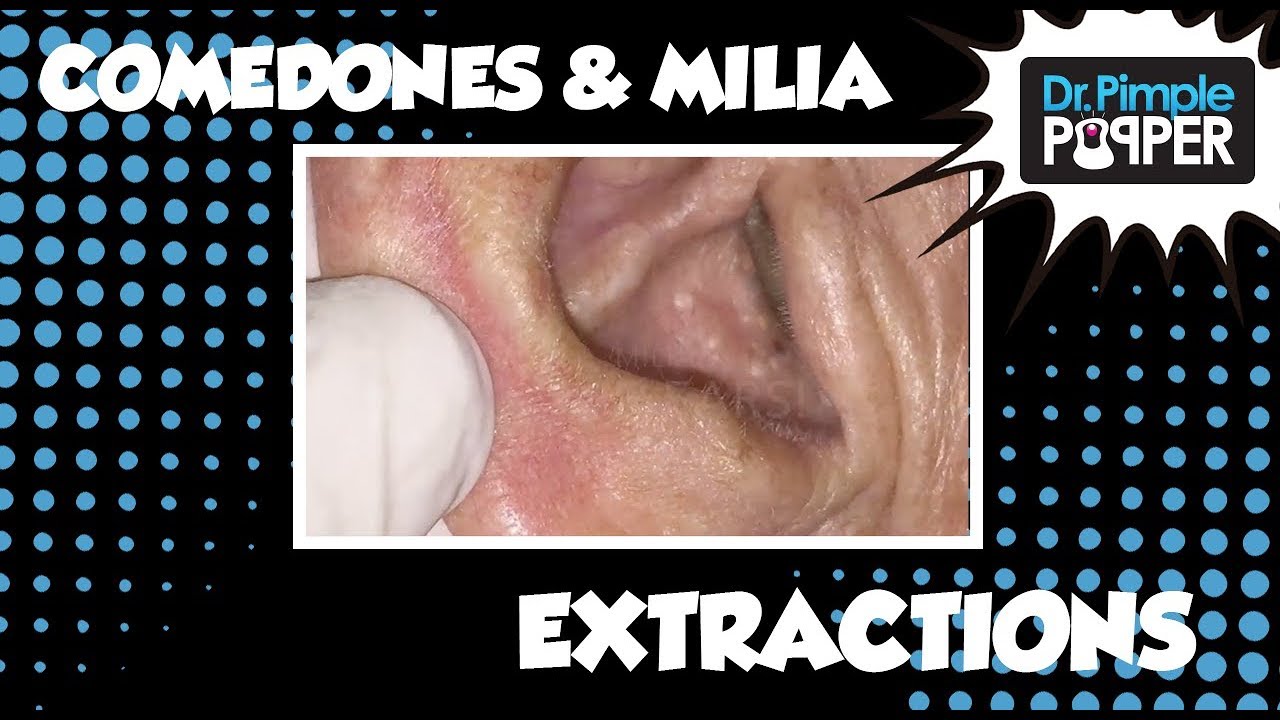 Blackheads on the Back & Milia in the Ears!