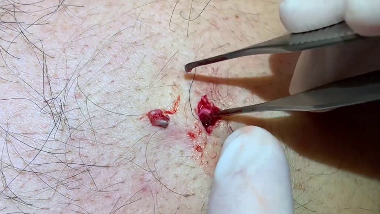 Blackheads on the back with a bonus cyst. Backxtractions. Ingrown hair removals. Waxy skin plugs.