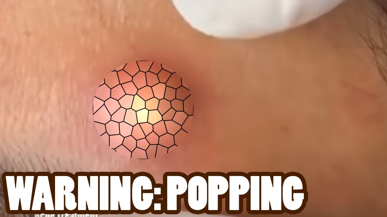 Blackheads on the Nose and Chin – Popping Week in Review