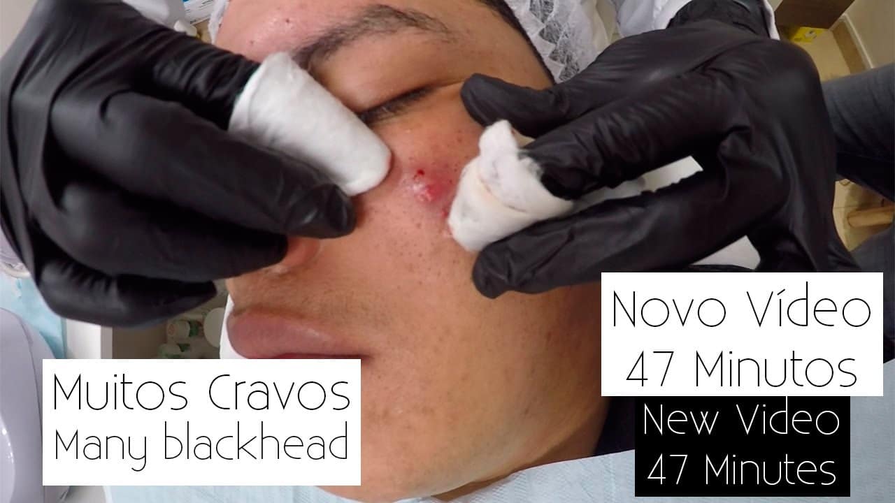 Blackheads Pimples – PART 3 Pele com muita Acne Limpeza de Pele Profunda – Doutora Acne Renata Lima