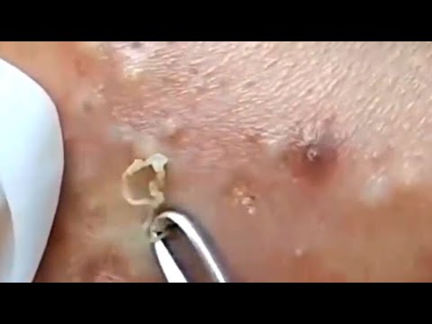 Blackheads Pimples Popping Video Face Skin Care With Calm Music #39