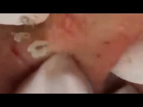 Blackheads Pimples Popping With Calm Music #214
