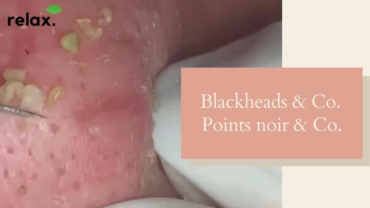 Blackheads, Pimples, Whiteheads Extraction acne pimple popping video