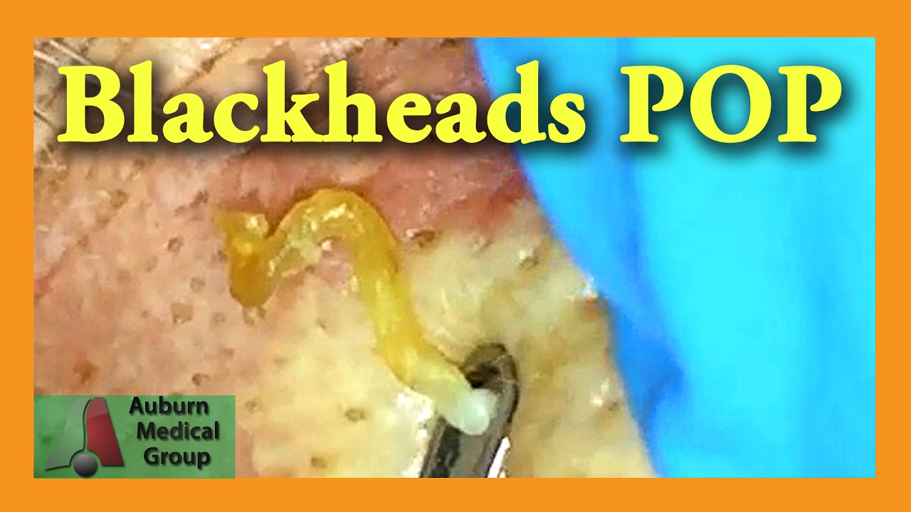 Blackheads POP! | Auburn Medical Group