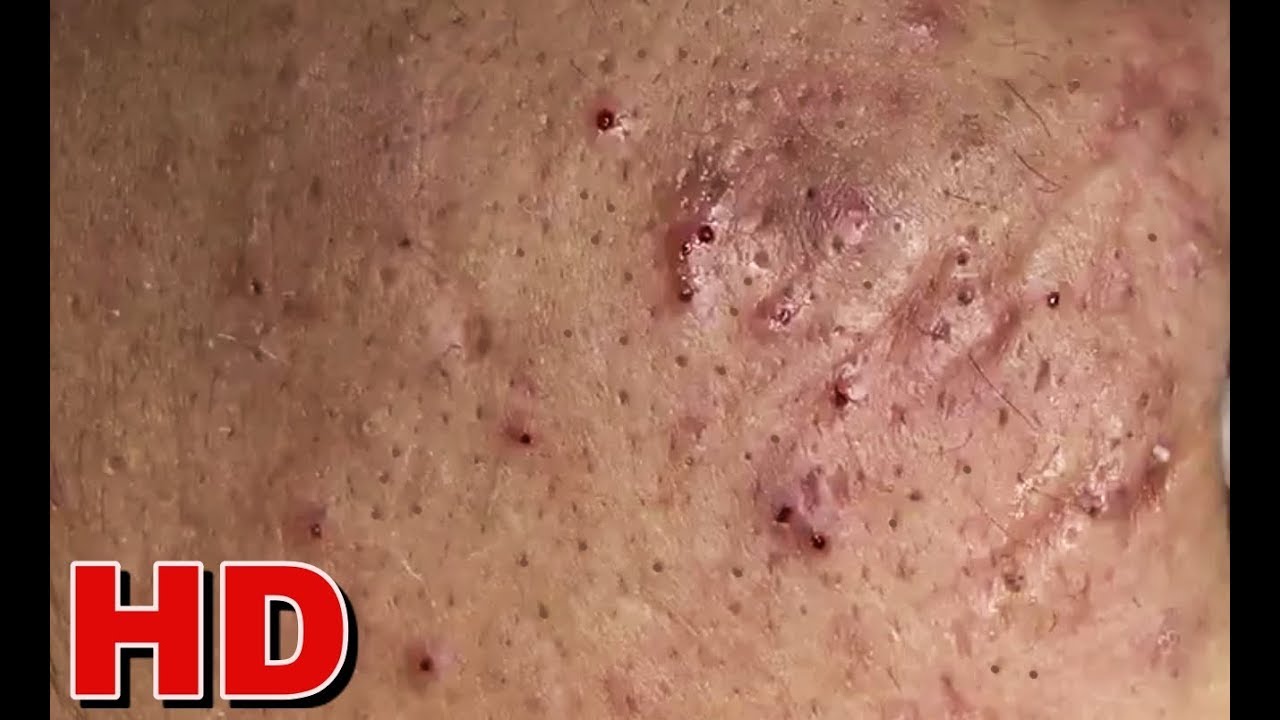 #blackheads #relaxing HD EXREME BLACKHEADS Extraction! 7