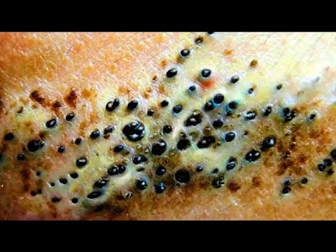 Blackheads removal 2020 pimple popping