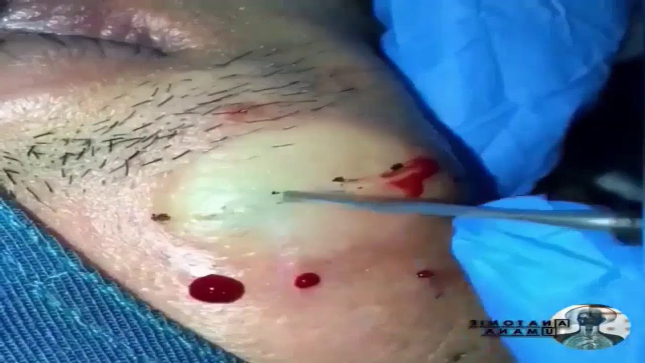 Blackheads Removal #26 – Best Pimple Popping Videos 2019