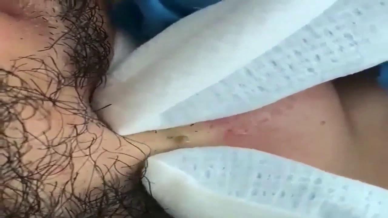 Blackheads Removal #32 – Best Pimple Popping Videos 2019
