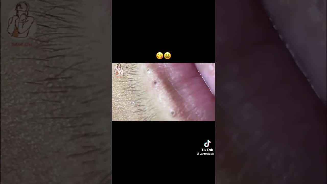 Blackheads Removal around the mouth