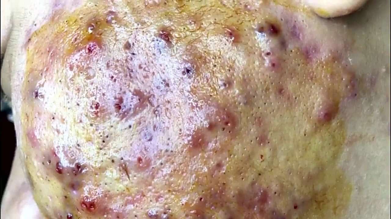 Blackheads Removal   Best Pimple Popping Videos with Sleep & Relaxing Top Music