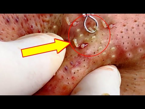 Blackheads Removal – Best Pimple Popping Videos
