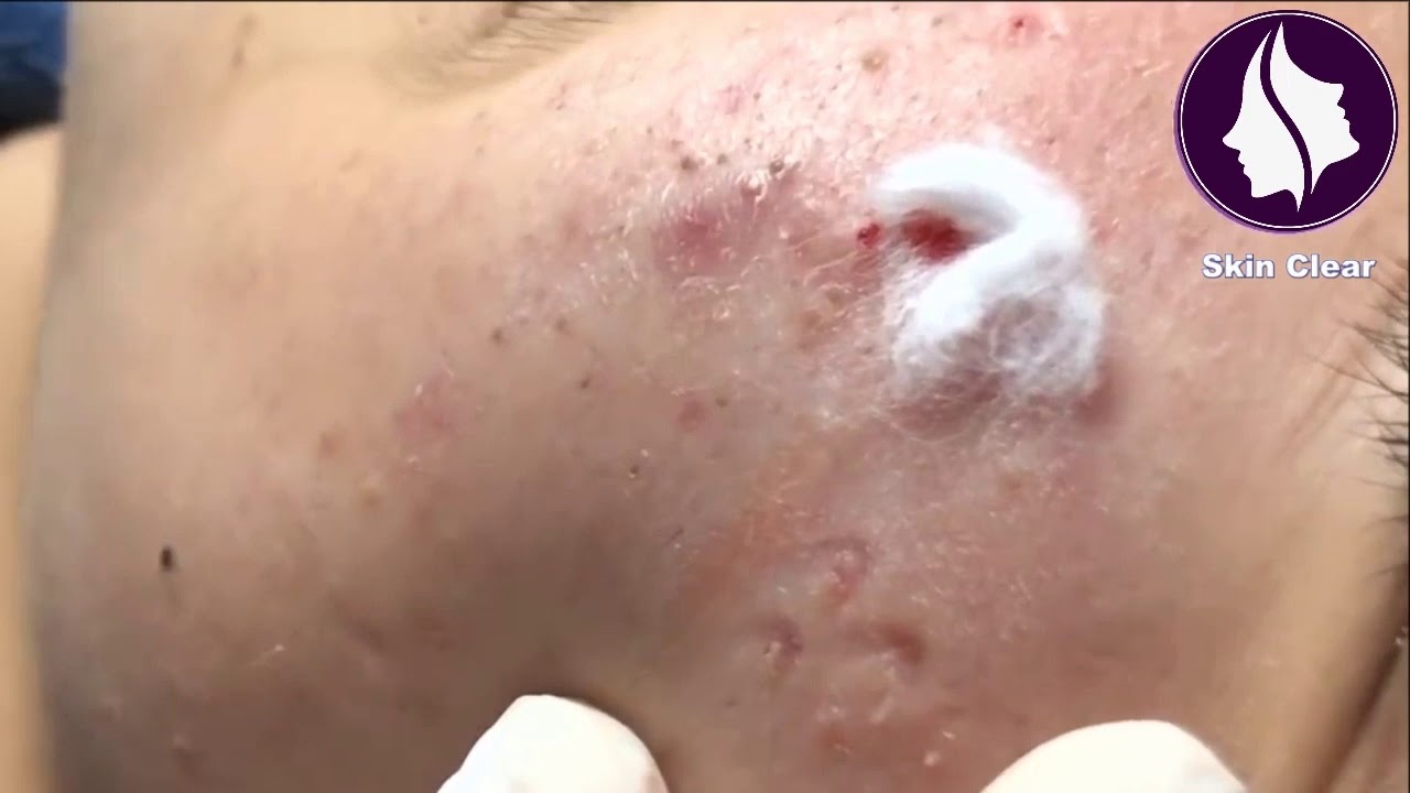 Blackheads Removal   Best Pimple Popping #27