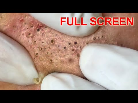 Blackheads removal – Best Pimple Popping Videos