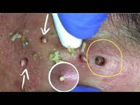 Blackheads Removal – Best Pimple Popping Videos #026