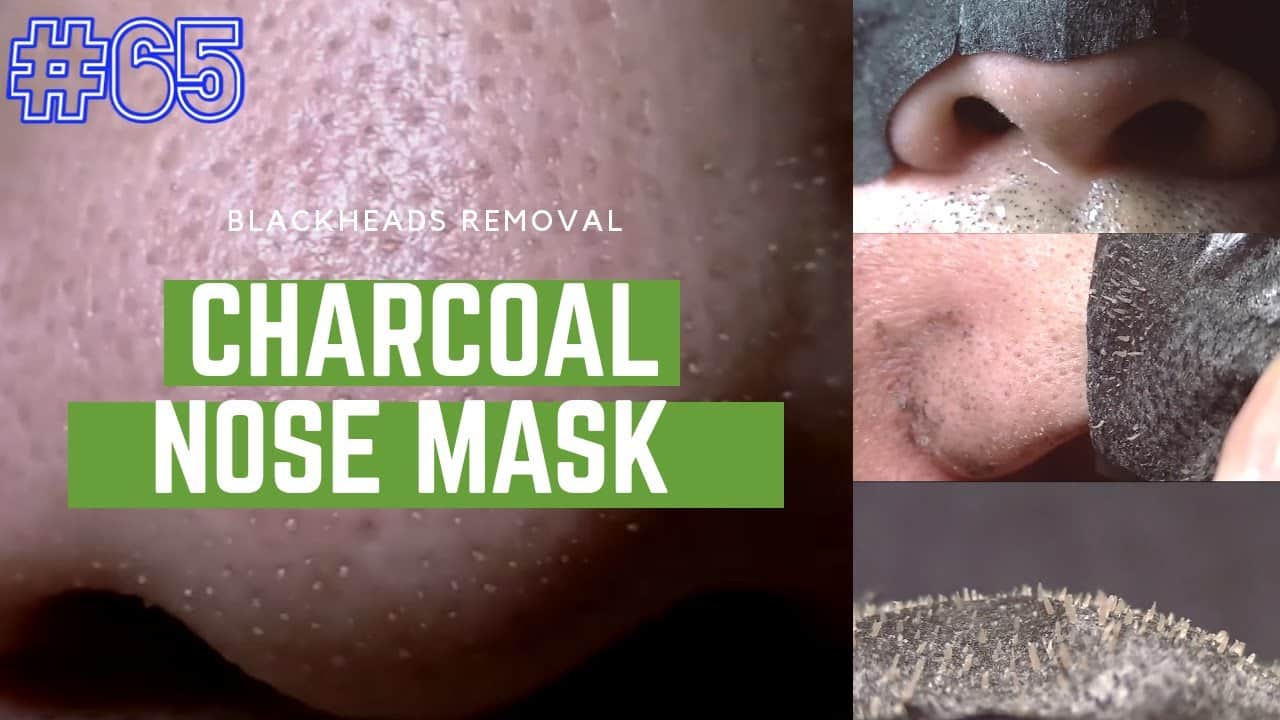 Blackheads removal – Charcoal Mask | Most Satisfying pimple Popping Videos