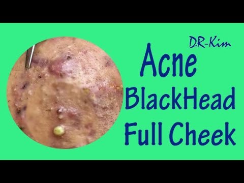 Blackheads Removal, Cyst Acne Treatment, Blackheads Extraction Best Pimple Popping