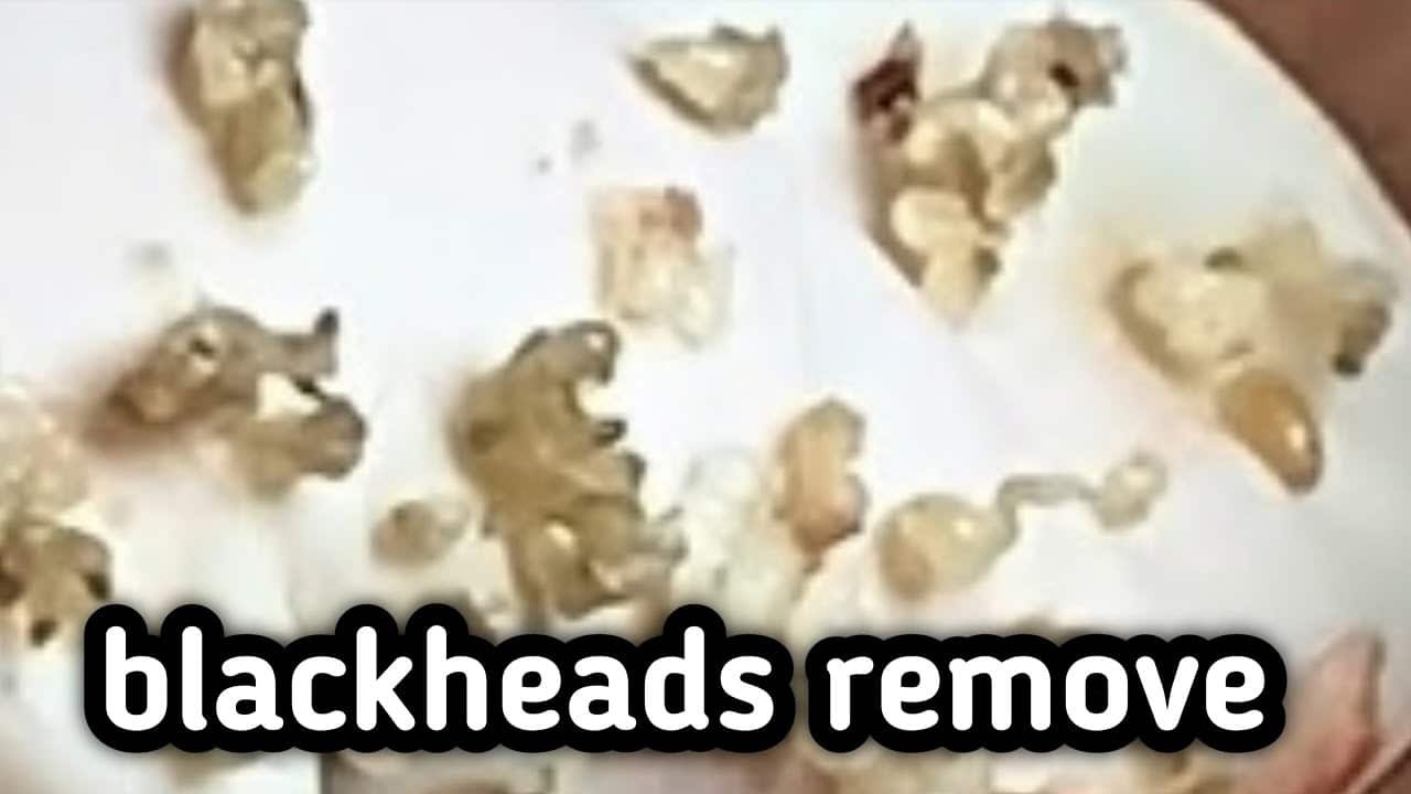 Blackheads Removal from Cheeks and Nose – Best Pimple Popping Videos#1