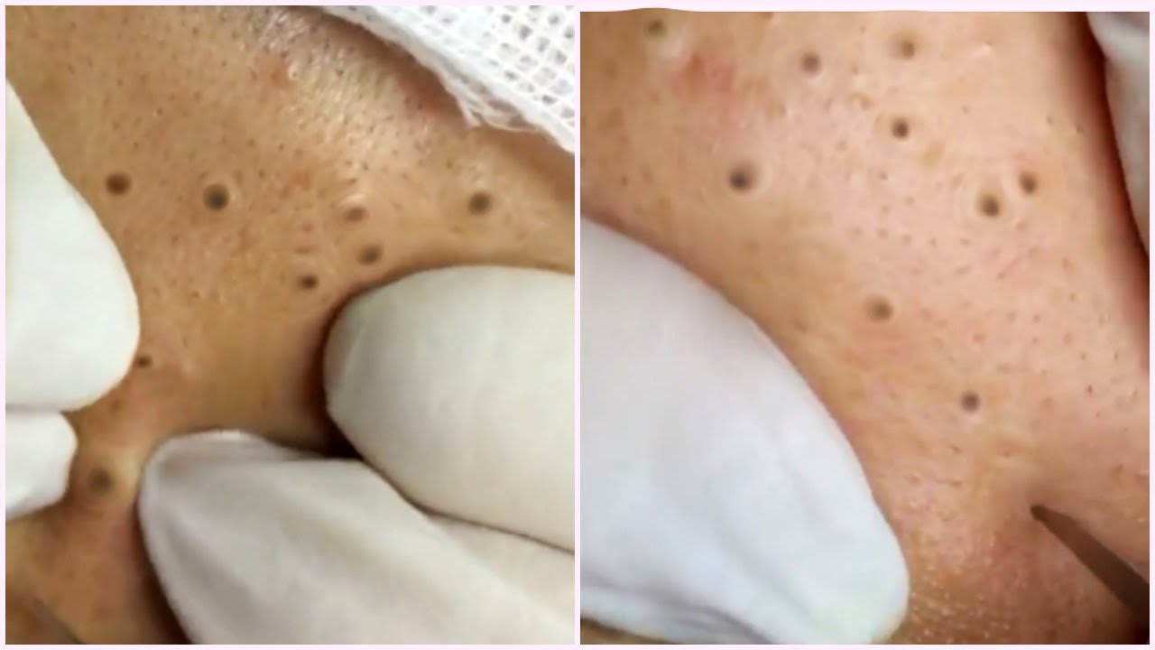 Blackheads Removal from Forehead and Cheeks – Best Pimple Popping Videos
