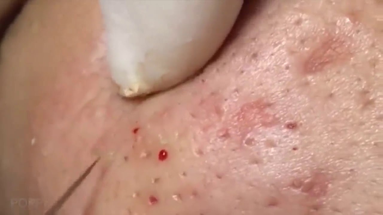 Blackheads Removal – Just Pimple Popping Videos