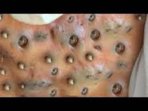Blackheads Removal & Pimple Popping Videos 2021 1