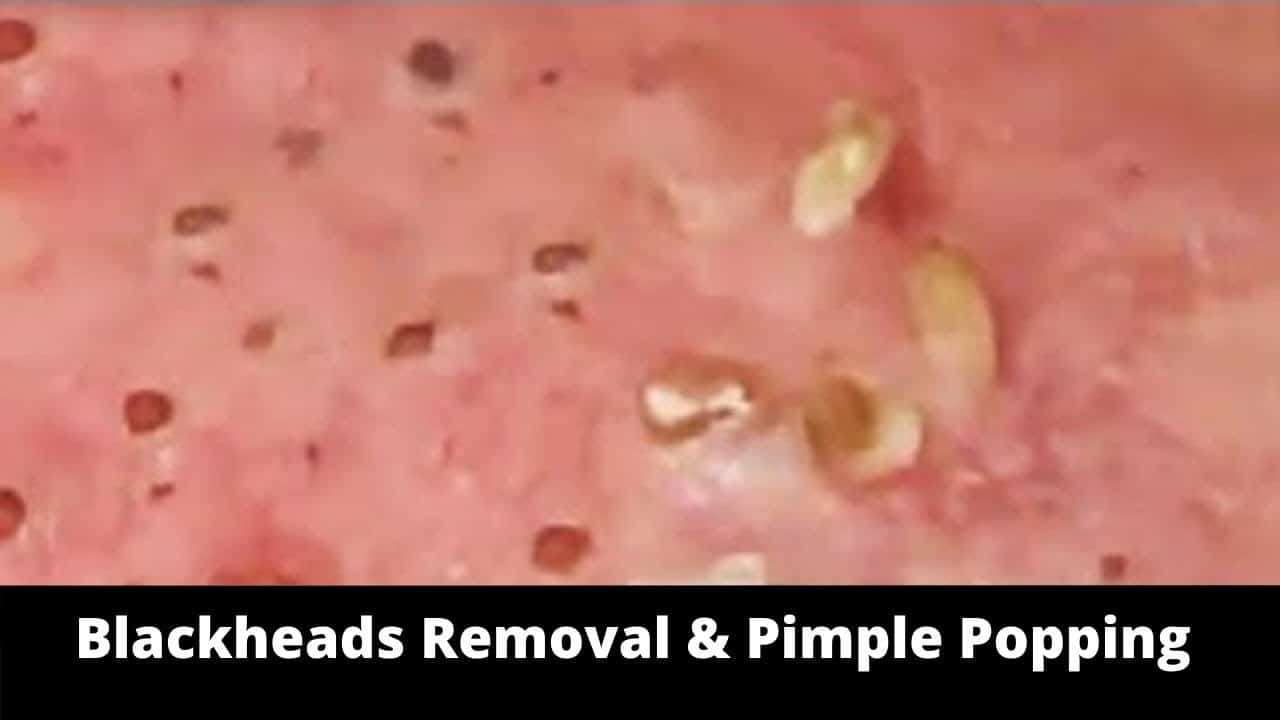 #Blackheads Removal & #Pimple Popping Videos #popping,#blackheads,#blackheadsremoval