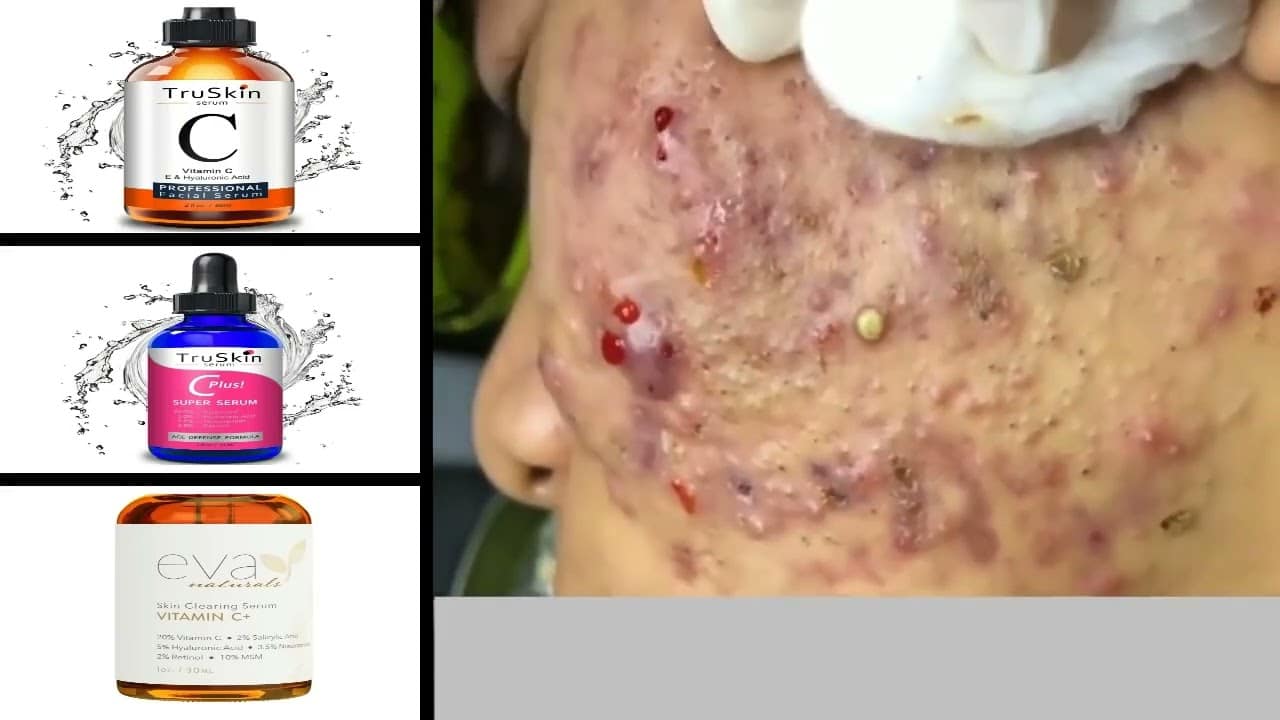 Blackheads Removal & Pimple Popping Videos 2022