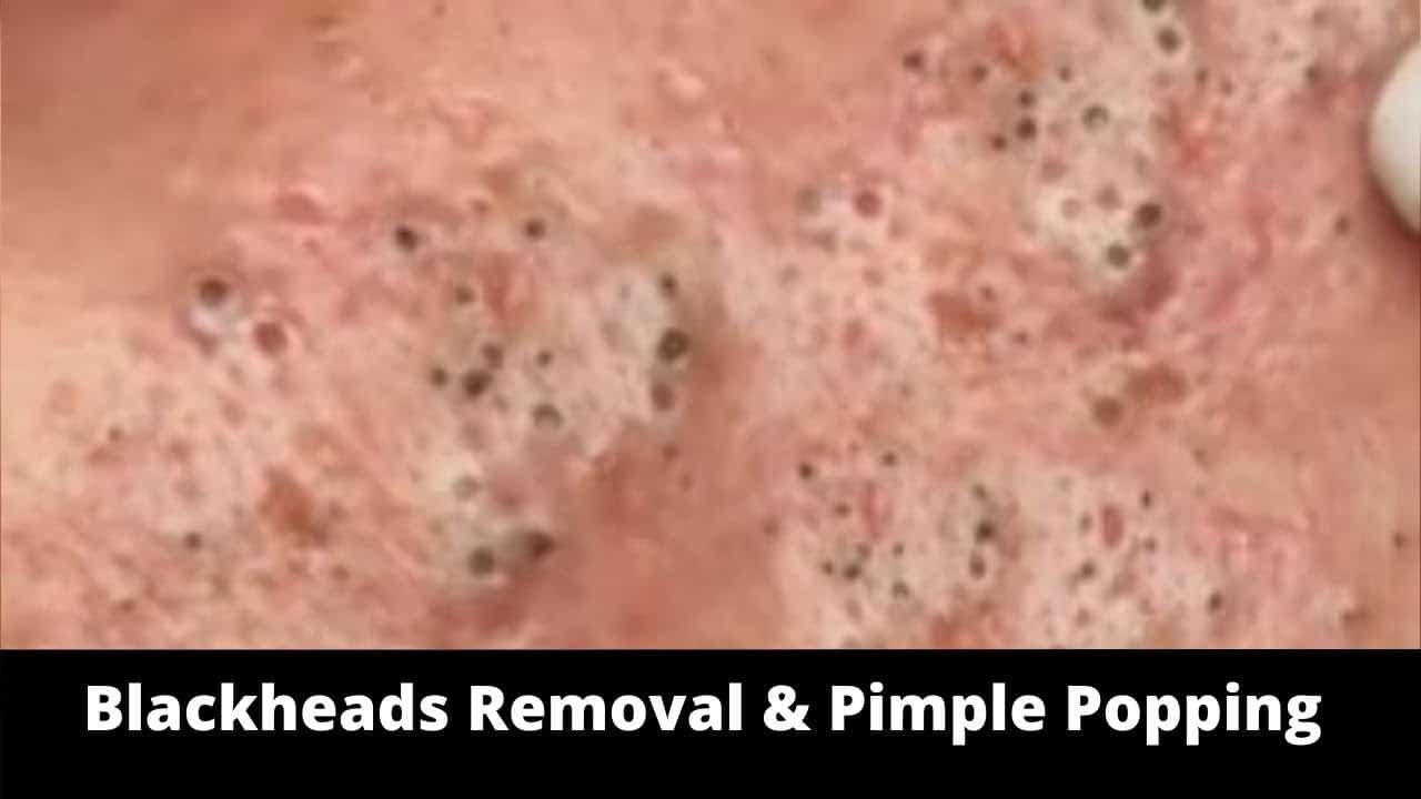 Blackheads Removal & Pimple Popping Videos 2020