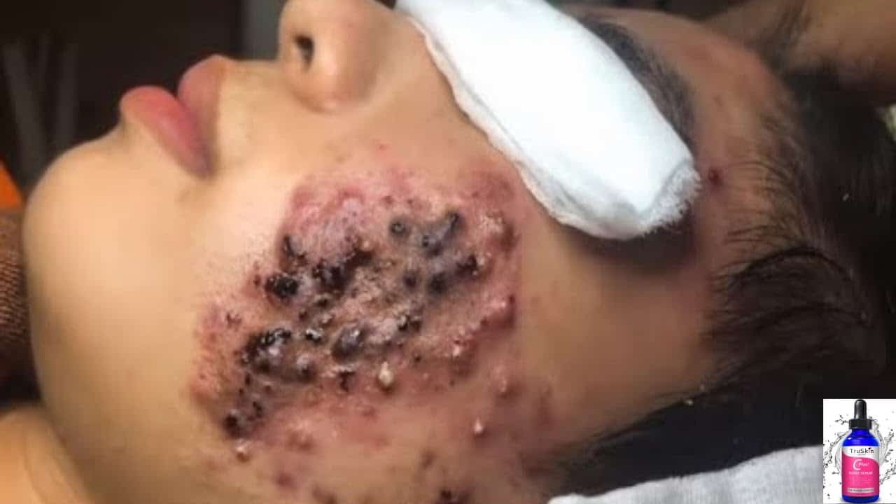 Blackheads Removal & Pimple Popping Videos 2020