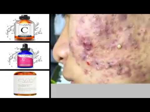 Blackheads Removal & Pimple Popping Videos 2022