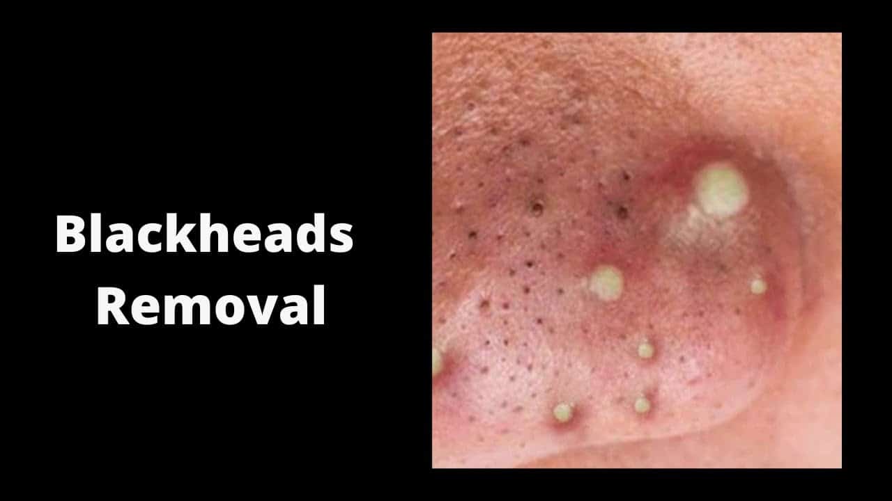 Blackheads Removal & Pimple Popping Videos 2020 #popping,#blackheads,#blackheadsremoval