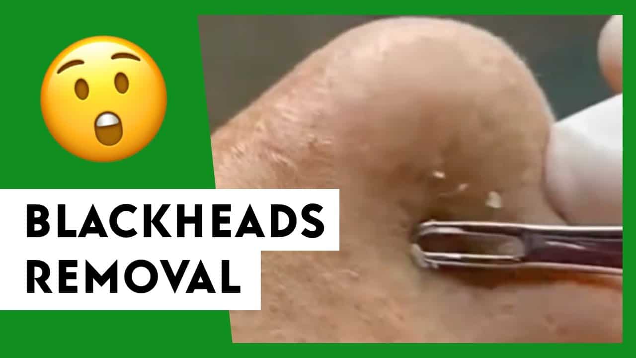 Blackheads Removal | Pimple Popping Videos 12