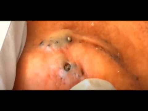 Blackheads Removal & Pimple Popping Videos #01 of 2021