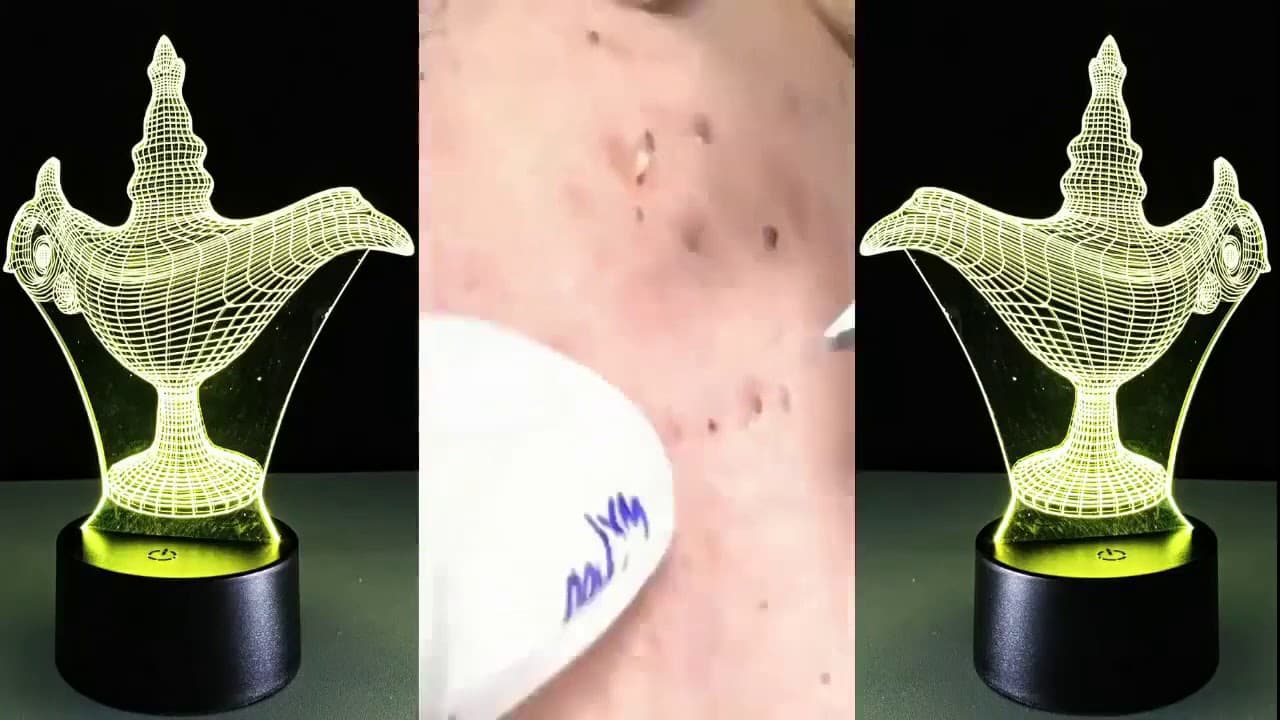 Blackheads Removal Whiteheads Cystic Acne Treatment Pimple Popping Remove Milia on Skin