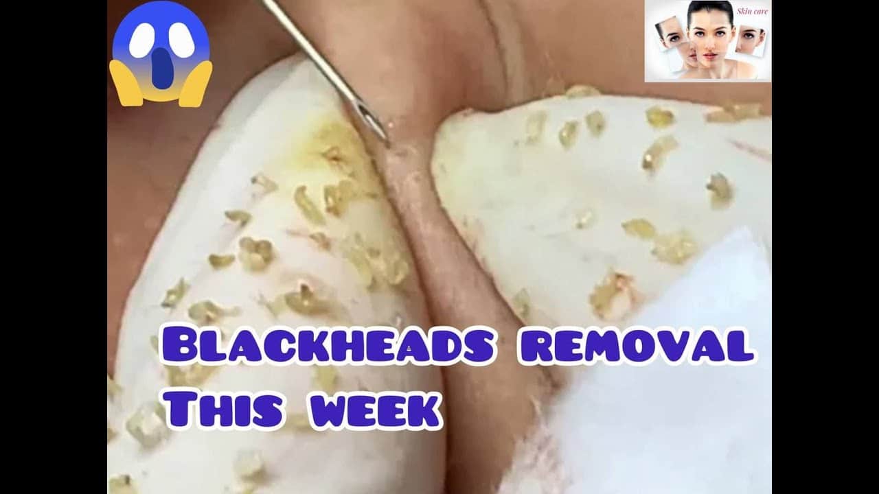 Blackheads remove this week , acne extraction , pimple popping#44