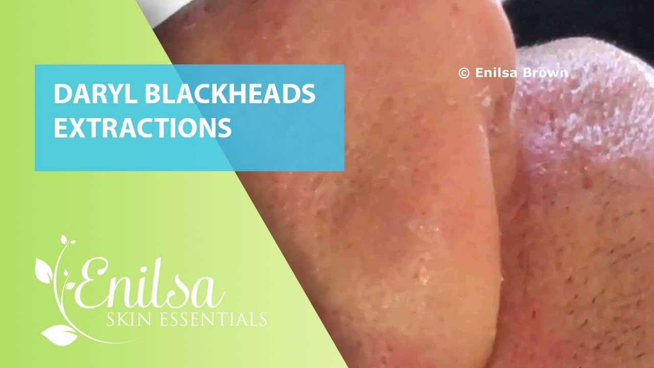 Blackheads & Small Cyst Extractions on Daryl