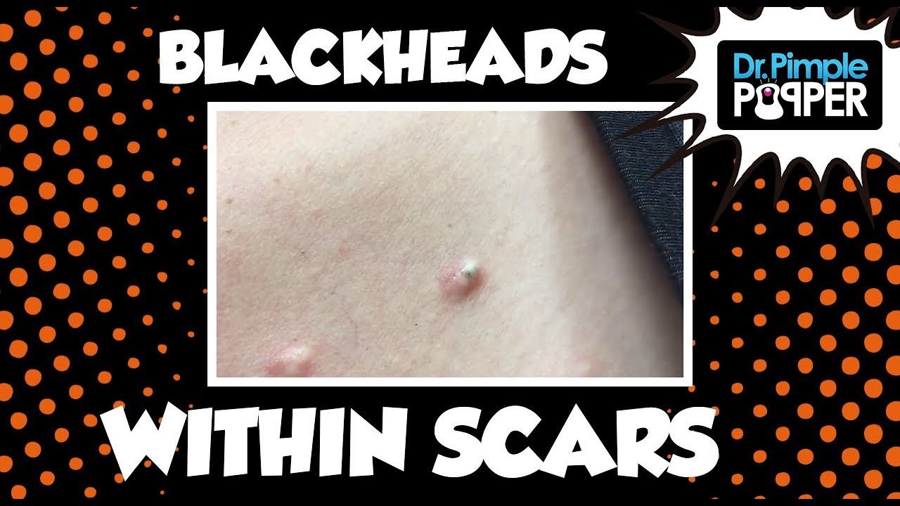 Blackheads, Some Within Hypertrophic Scars