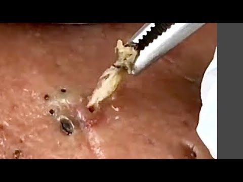 Blackheads.Thank you for watching?