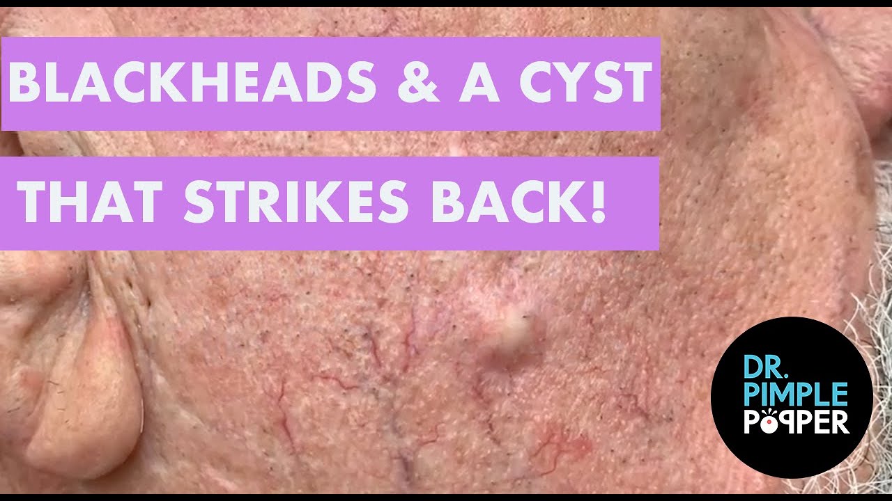 BLACKHEADS & The Cyst that Strikes Back