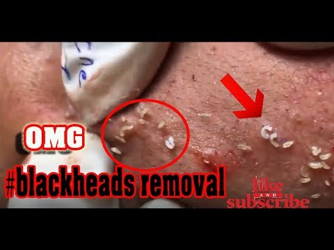 BLACKHEADS & THE Cyst that Strikes Back [EP2]