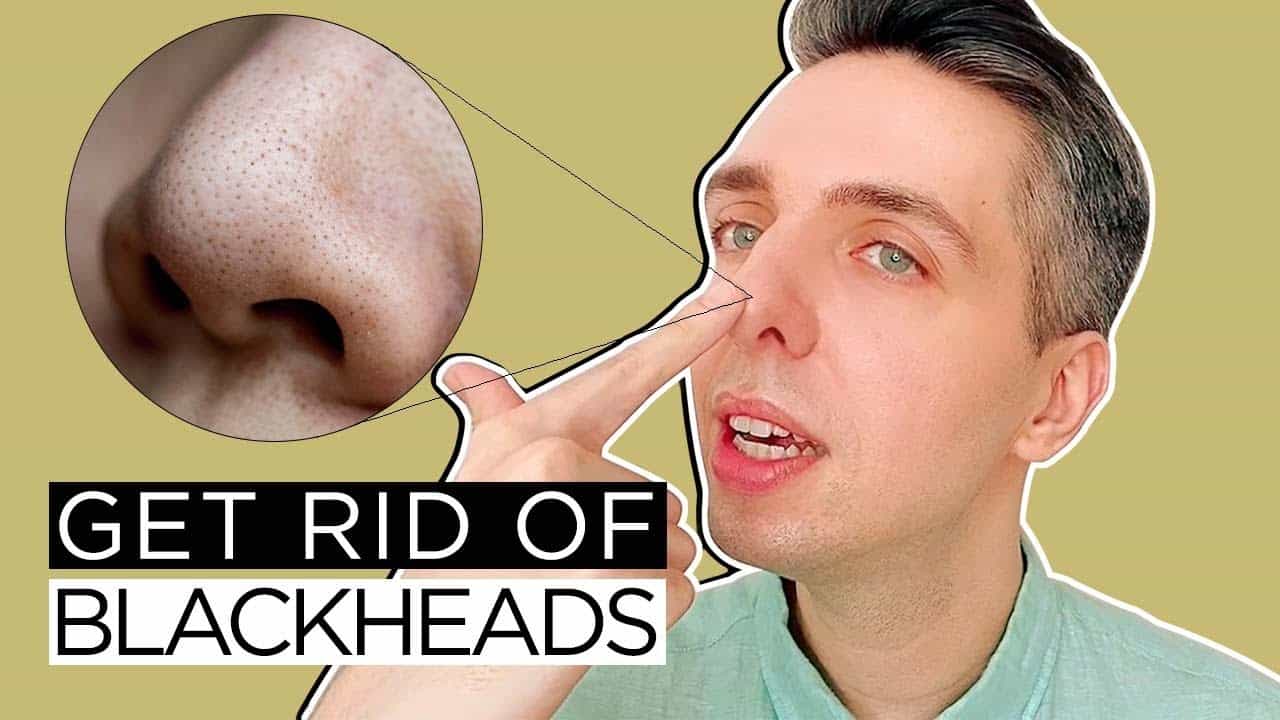 Blackheads Treatment at Home – How to Finally Get Rid of Them!