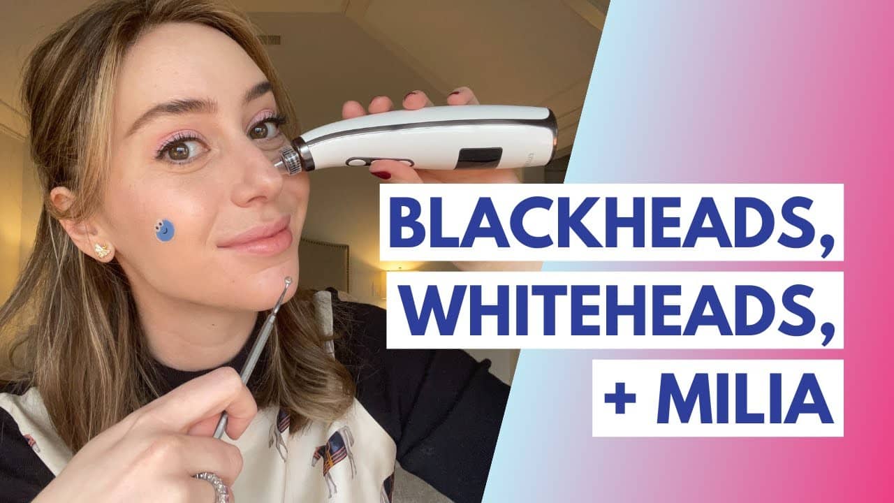 Blackheads vs. Whiteheads vs. Milia: What is the Difference + How to Treat! | Dr. Shereene Idriss