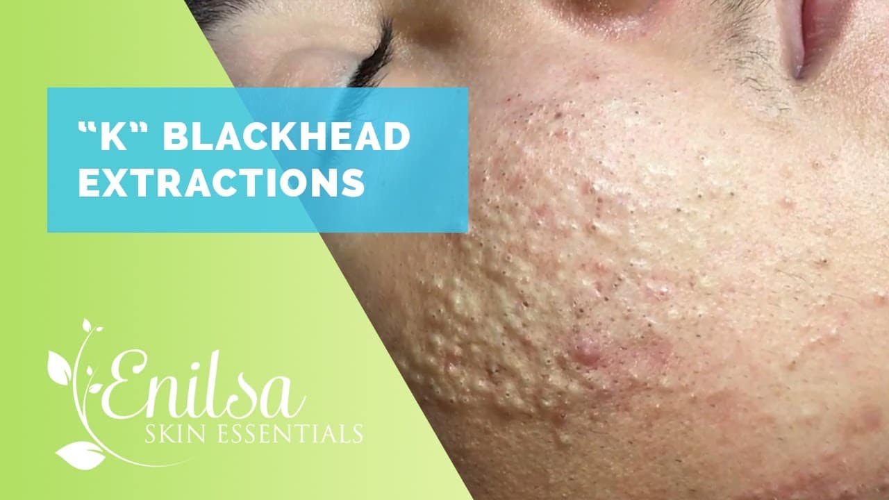 Blackheads, Whiteheads Extractions on "K"