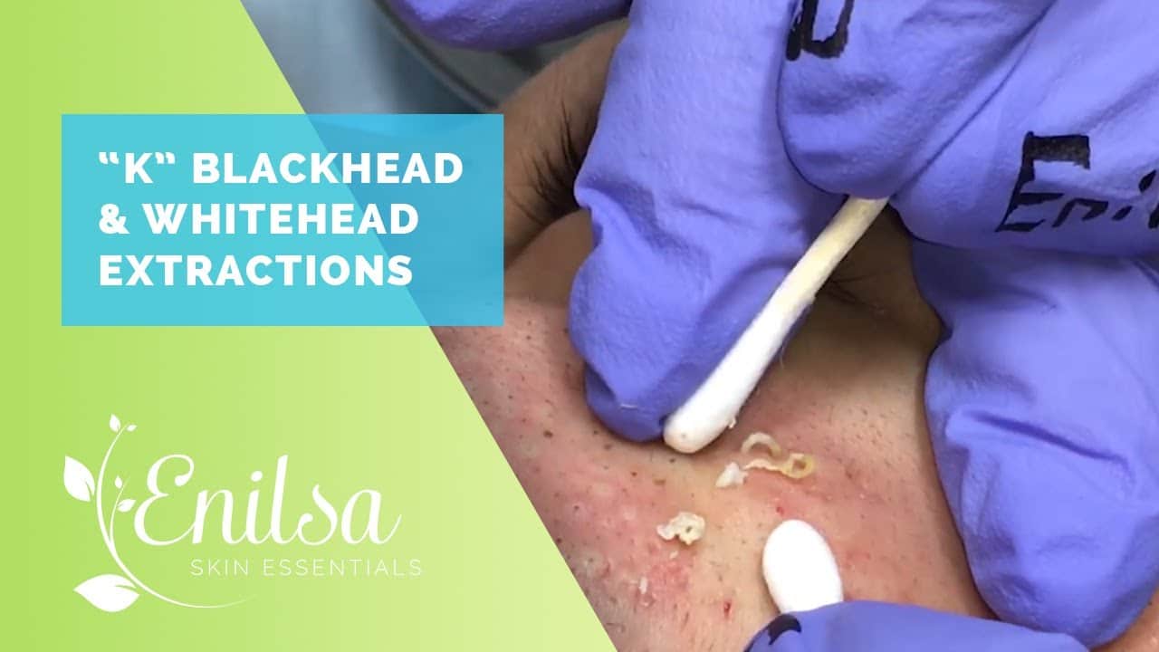 Blackheads, Whiteheads Extractions on "K" – Part 2