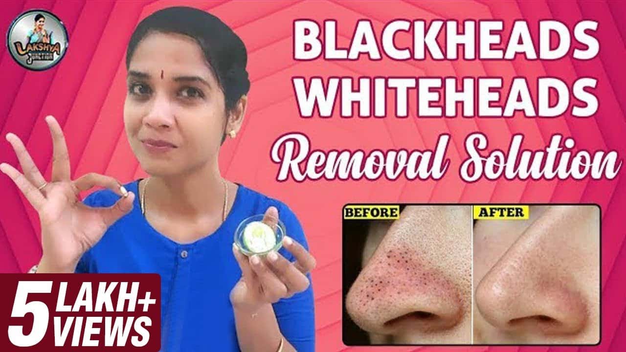 Blackheads Whiteheads | Homemade Removal Solution | Lakshya Junction