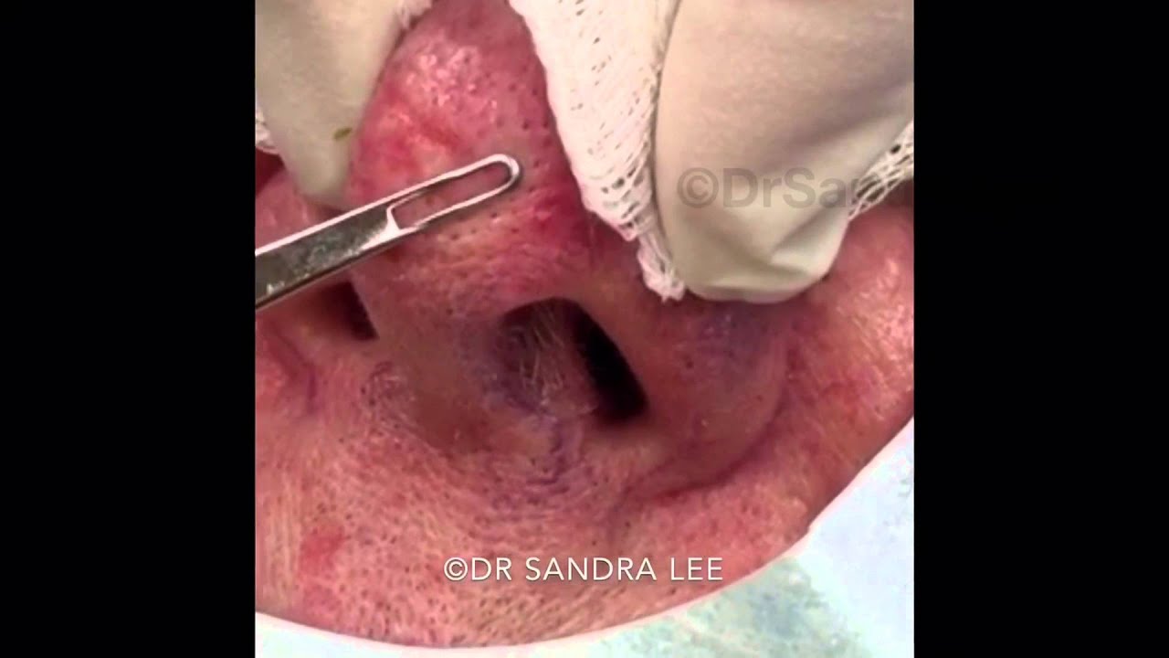 Blackheads & Whiteheads on the Nose. For medical education- NSFE.