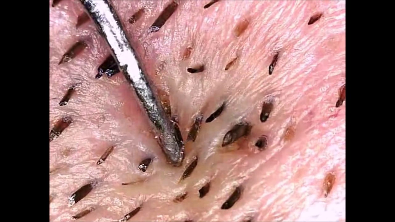 Blackheads, Whiteheads, Pimples & Cysts by Mr Blackhead (Microscope)