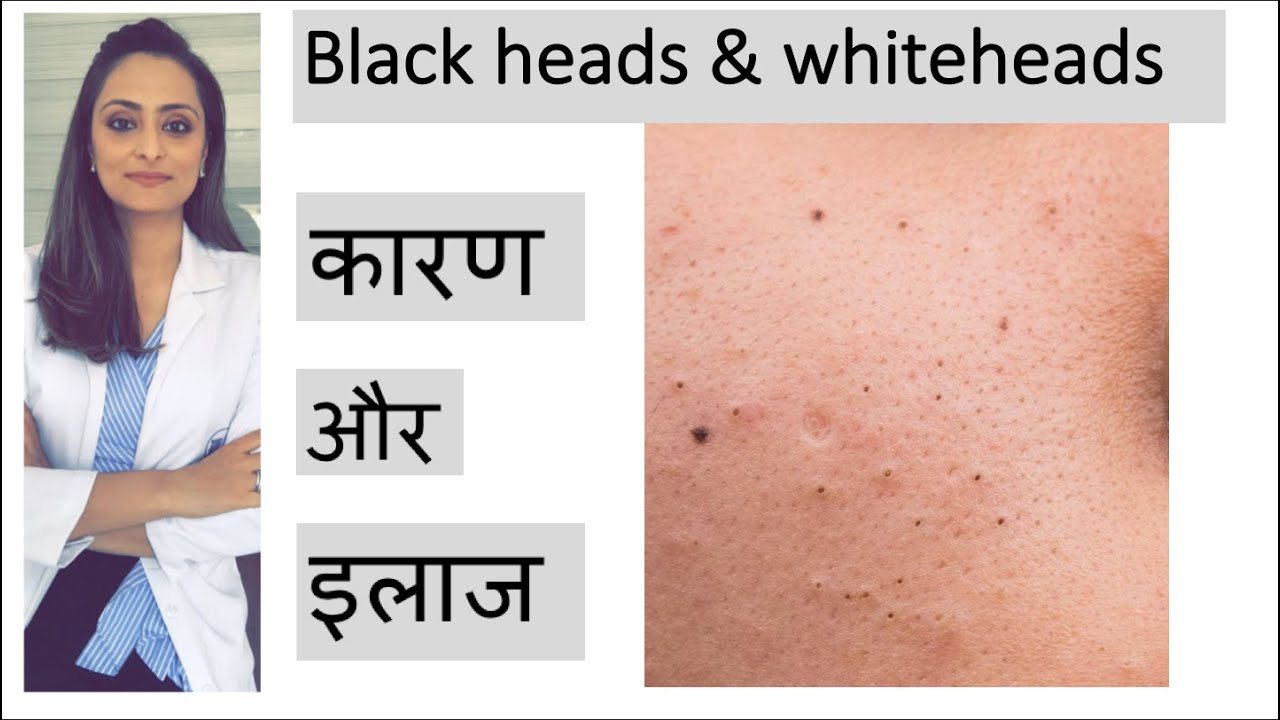 blackheads whiteheads| treatment | ब्लाक हेड्ज़ को कैसे निकाले | त्वचा के डॉक्टर