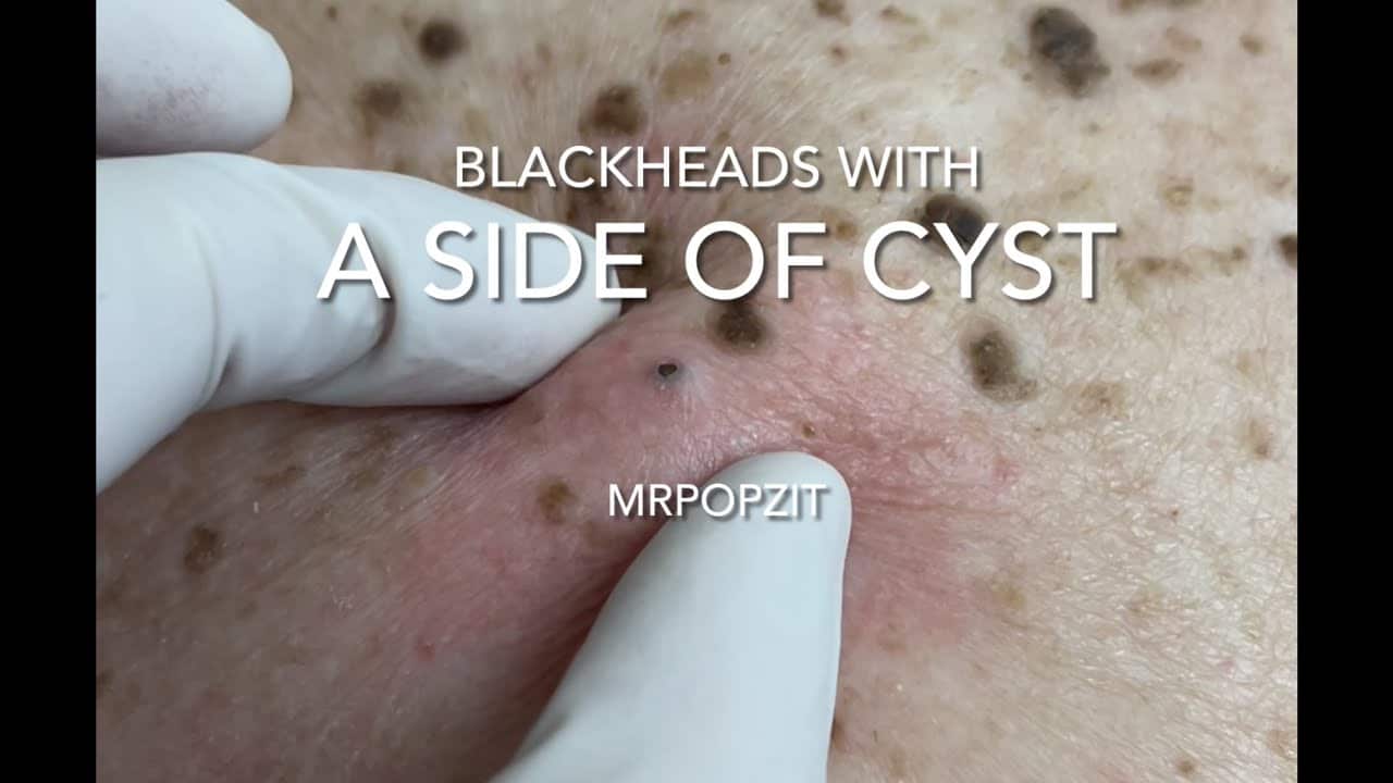 Blackheads with a side of cyst.Blackhead extractions and cyst excision with closure.Cyst dissection