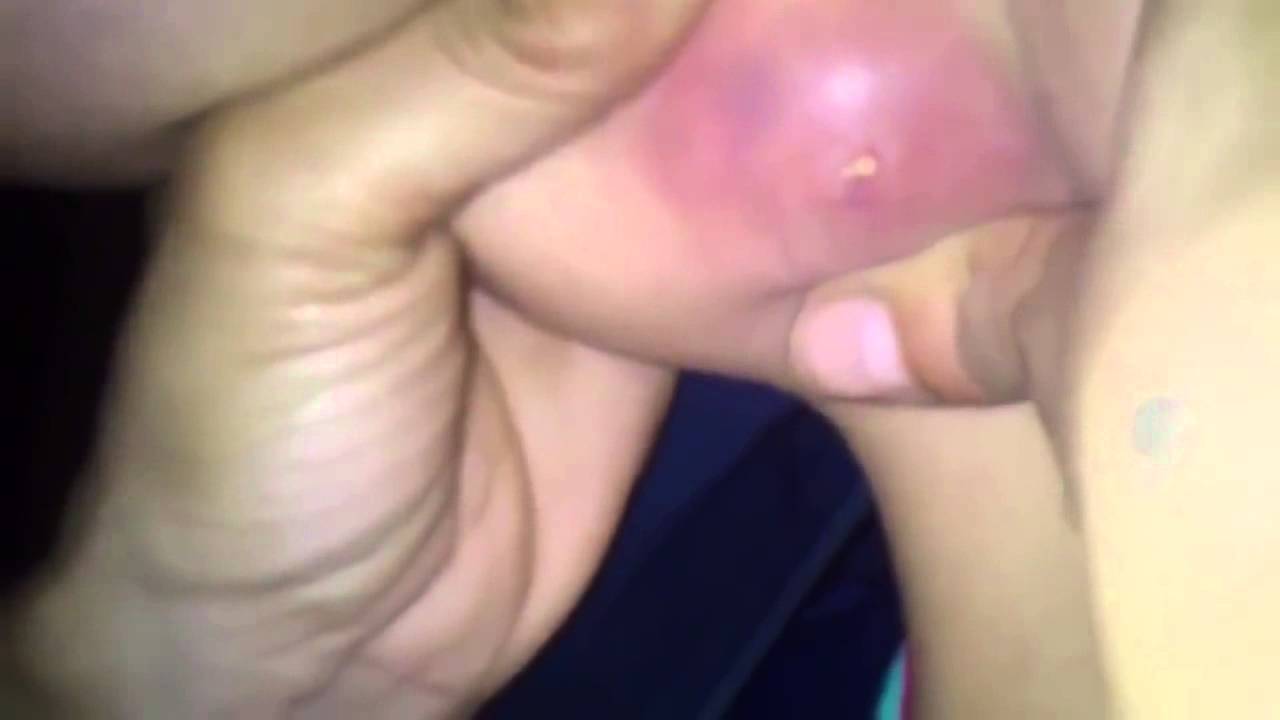 Blasting huge pimple in armpit